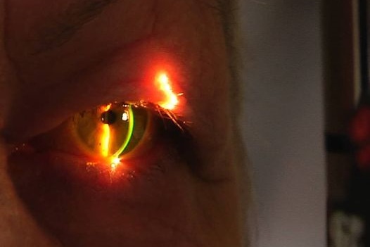 Glaucoma