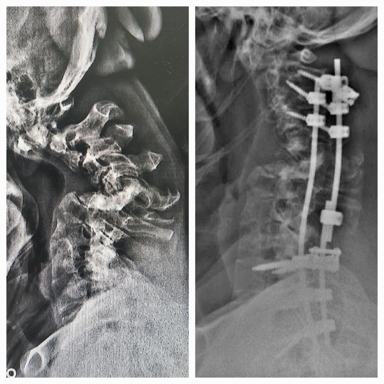 Neurocirurgia da coluna